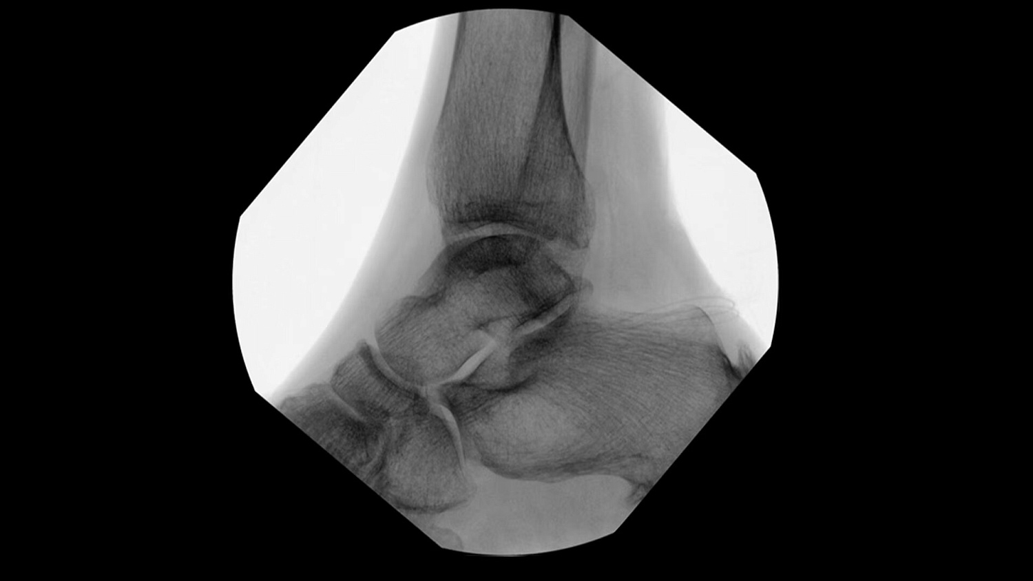 Мобильный рентгеновский аппарат с С-дугой GE OEC Elite MiniView