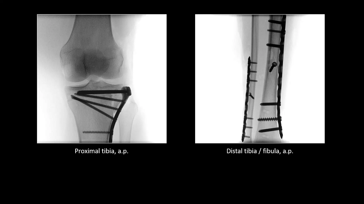 Мобильный рентгеновский аппарат с С-дугой Siemens Cios Select