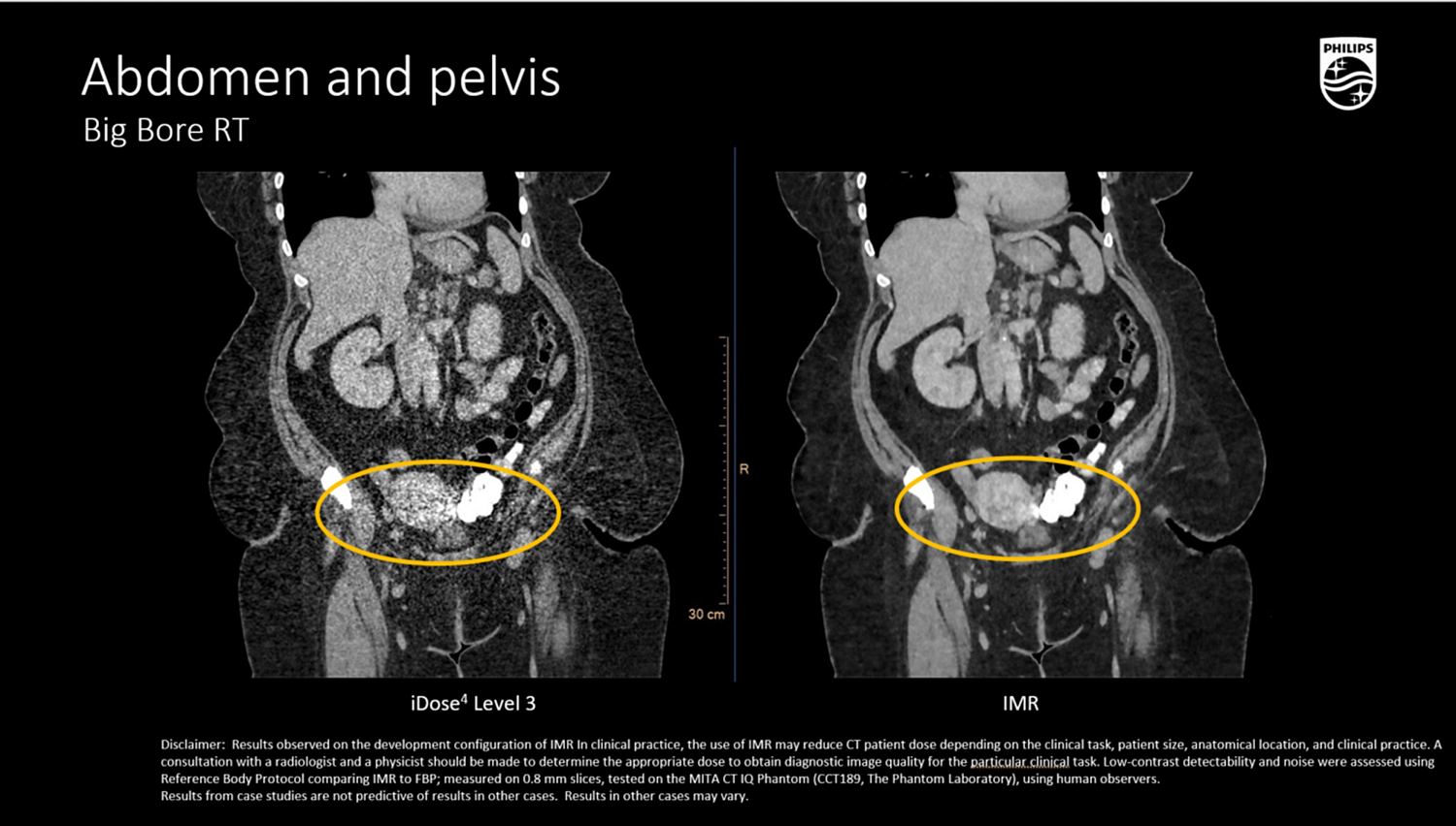 Компьютерный томограф Philips CT Big Bore