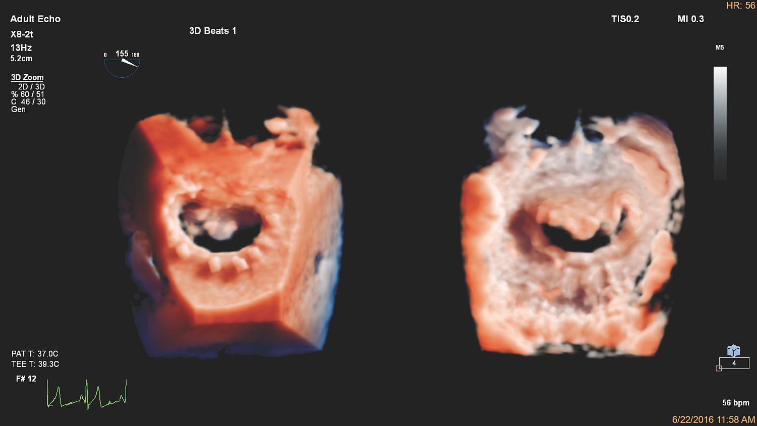 УЗИ аппарат Philips EPIQ CVx