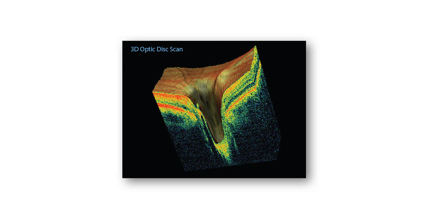 Optovue iScan