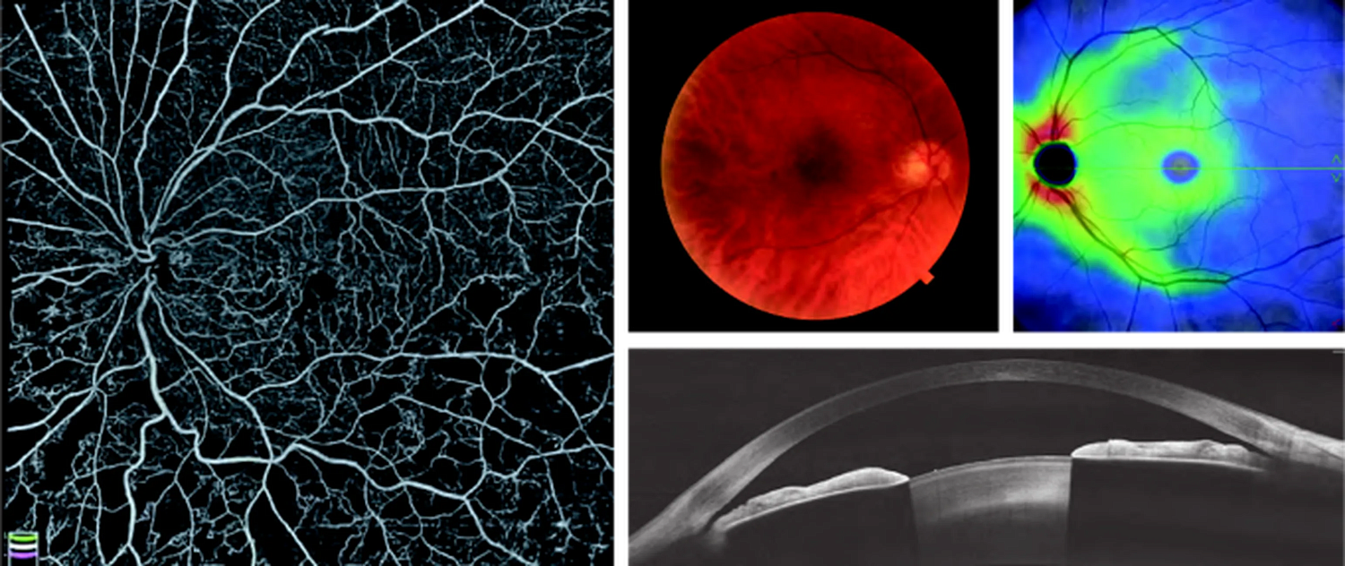 Optovue SOLIX