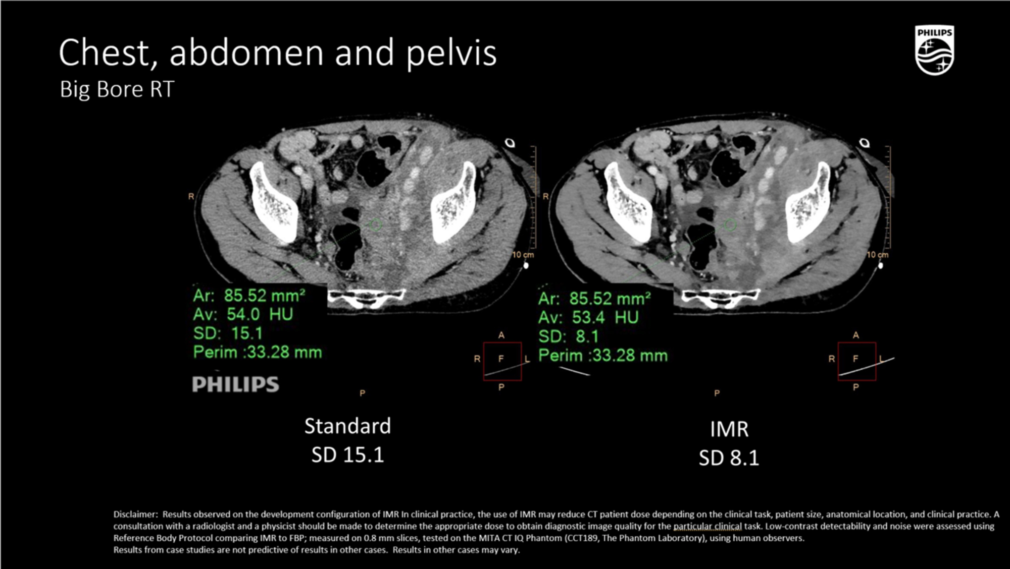 Компьютерный томограф Philips CT Big Bore