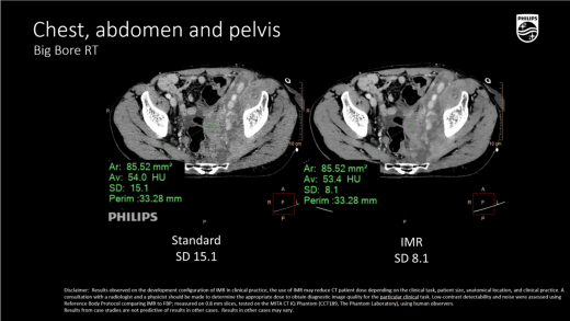 Компьютерный томограф Philips CT Big Bore