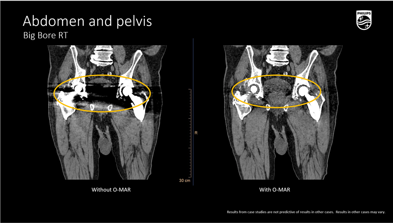 Компьютерный томограф Philips CT Big Bore