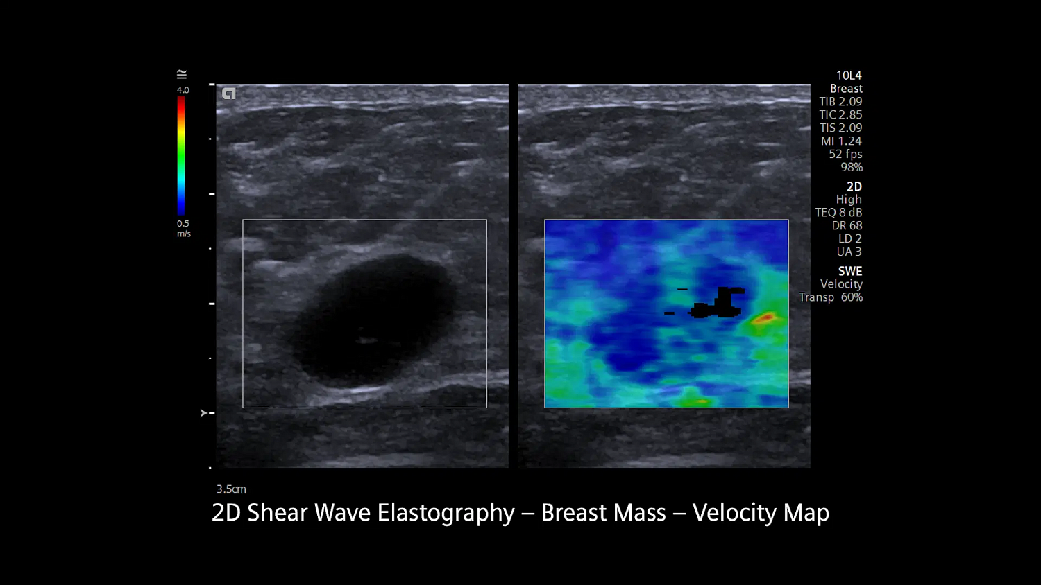 Ультразвуковая система Siemens ACUSON Redwood