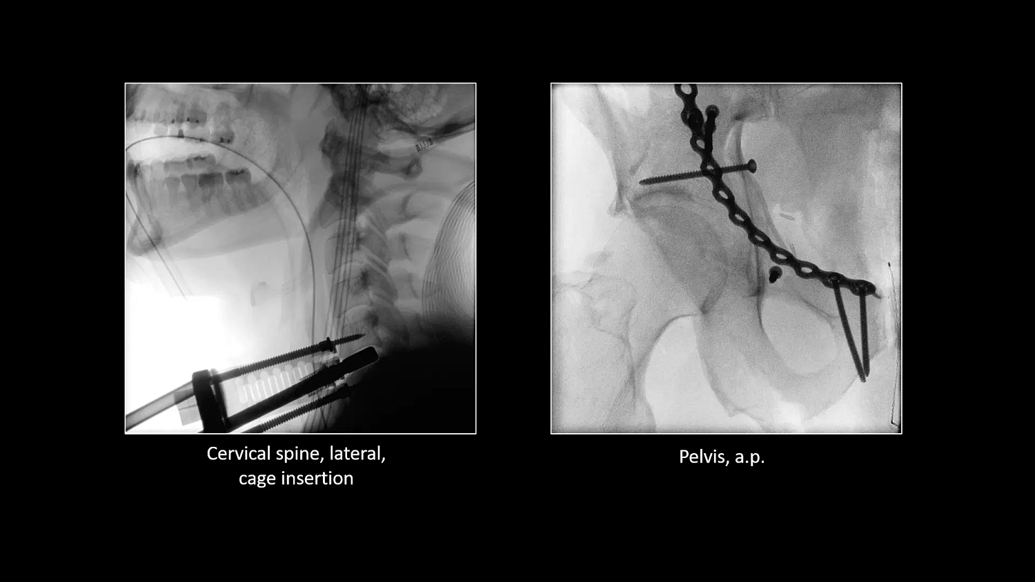 Мобильный рентгеновский аппарат с С-дугой Siemens Cios Select