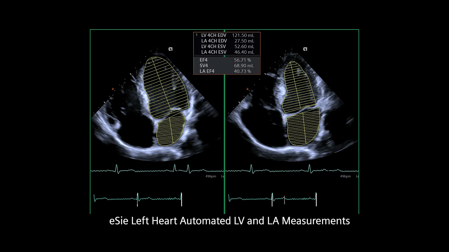 Ультразвуковая система Siemens ACUSON Redwood