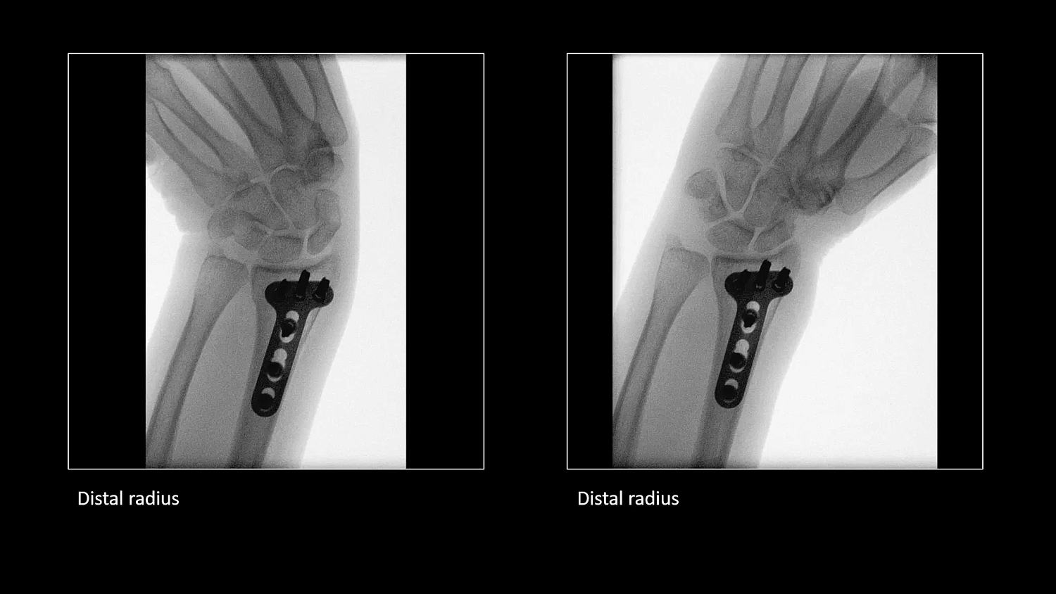 Мобильный рентгеновский аппарат с С-дугой Siemens Cios Select