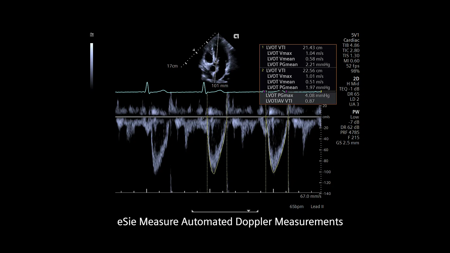 Ультразвуковая система Siemens ACUSON Redwood