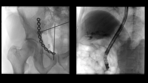 Мобильный рентгенохирургический аппарат с С-дугой Siemens Cios Flow