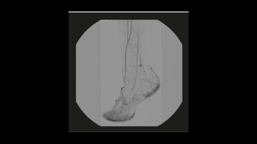 Мобильный рентгеновский аппарат с С-дугой GE OEC Elite CFD