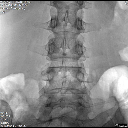 С.П. Гелпик «РЕНЕКС» 5,3 кВт мобильный рентгенохирургический аппарат типа С-дуга с плоскопанельным детектором