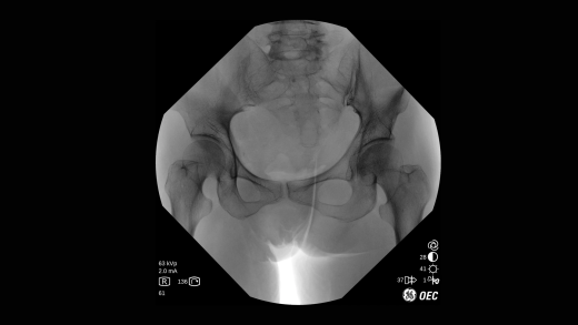 Мобильный рентгеновский аппарат с С-дугой GE OEC One CFD