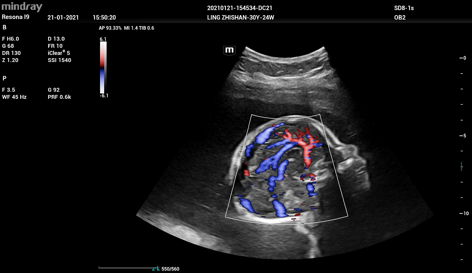 Ультразвуковой аппарат Mindray Imagyn I9