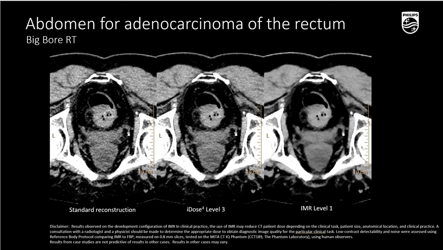 Компьютерный томограф Philips CT Big Bore