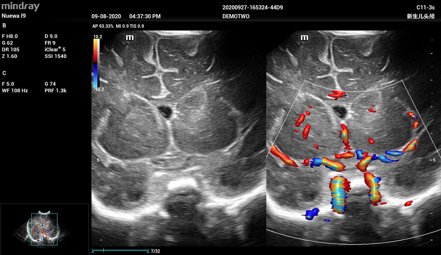 Ультразвуковой аппарат Mindray Imagyn I9