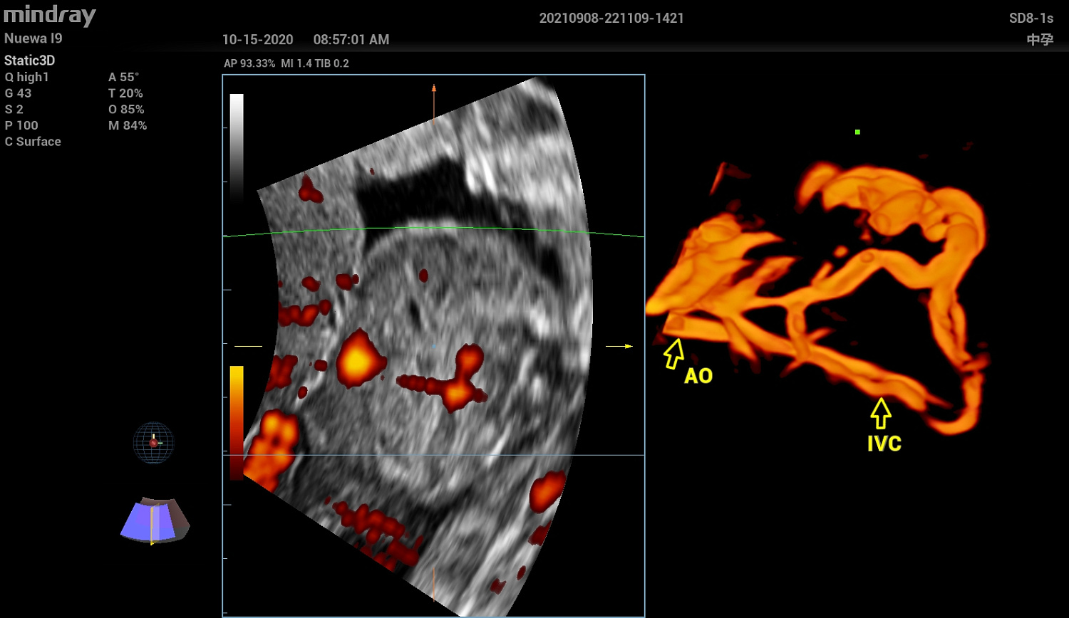 Ультразвуковой аппарат Mindray Imagyn I9