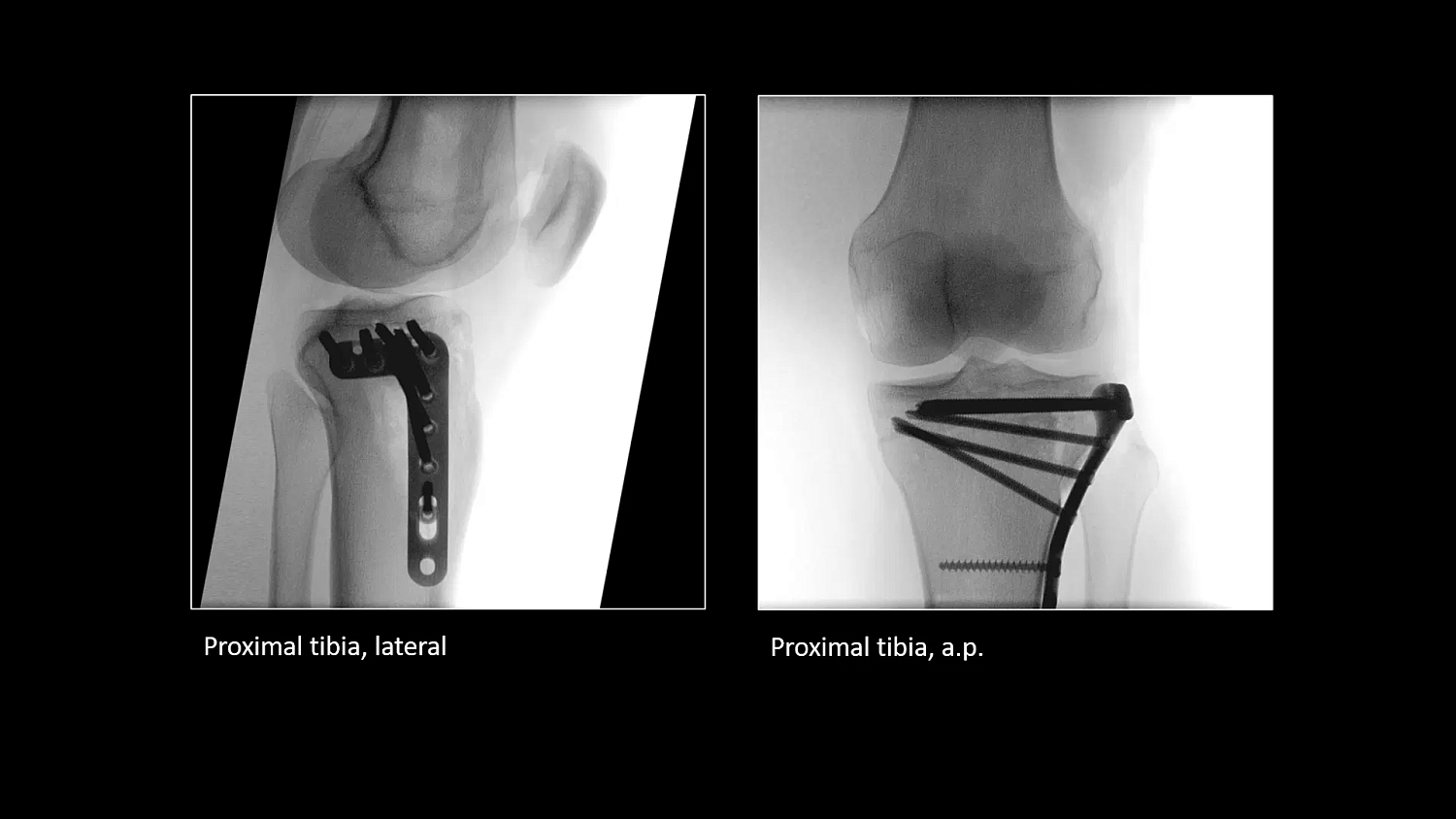 Мобильный рентгеновский аппарат с С-дугой Siemens Cios Select