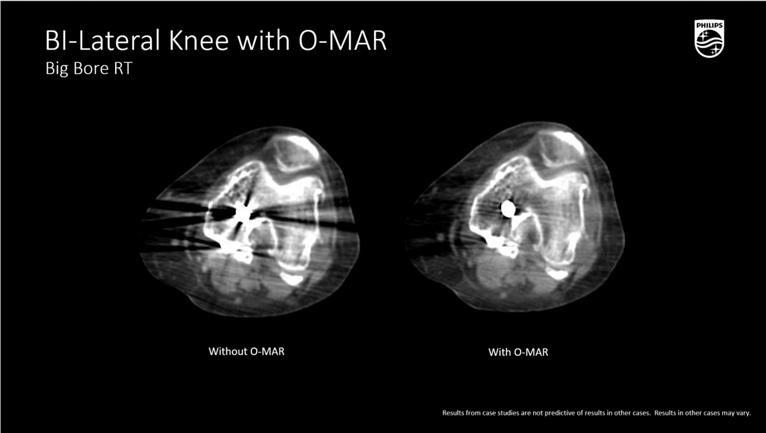 Компьютерный томограф Philips CT Big Bore