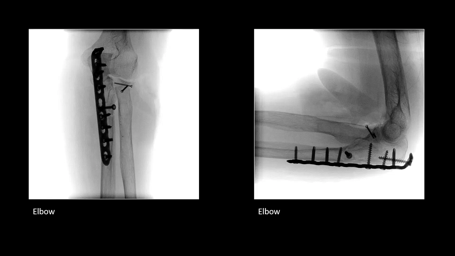 Мобильный рентгеновский аппарат с С-дугой Siemens Cios Select
