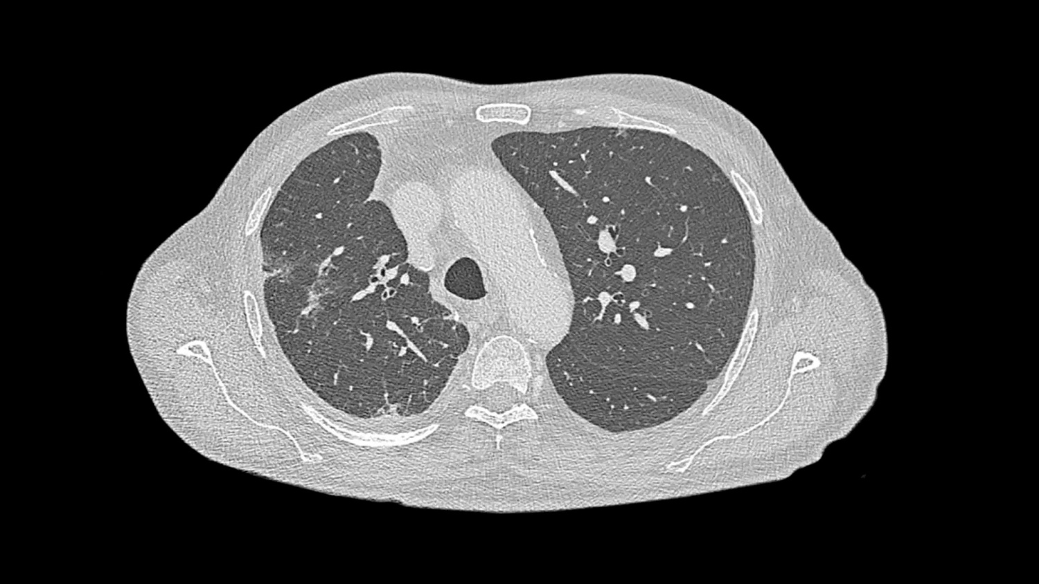 Компьютерный томограф Siemens NAEOTOM Alpha