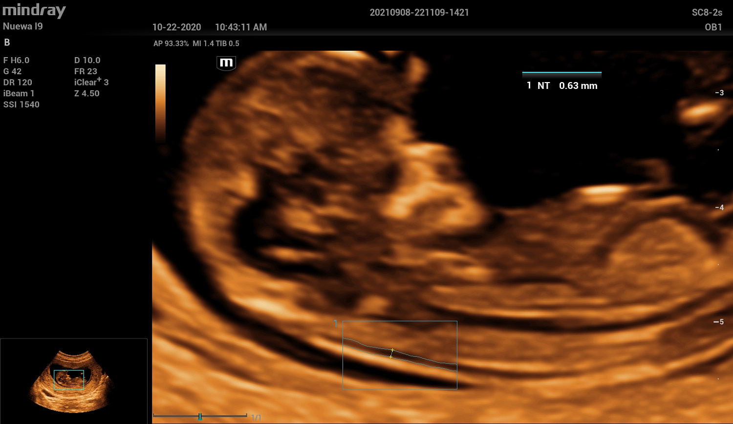 Ультразвуковой аппарат Mindray Imagyn I9