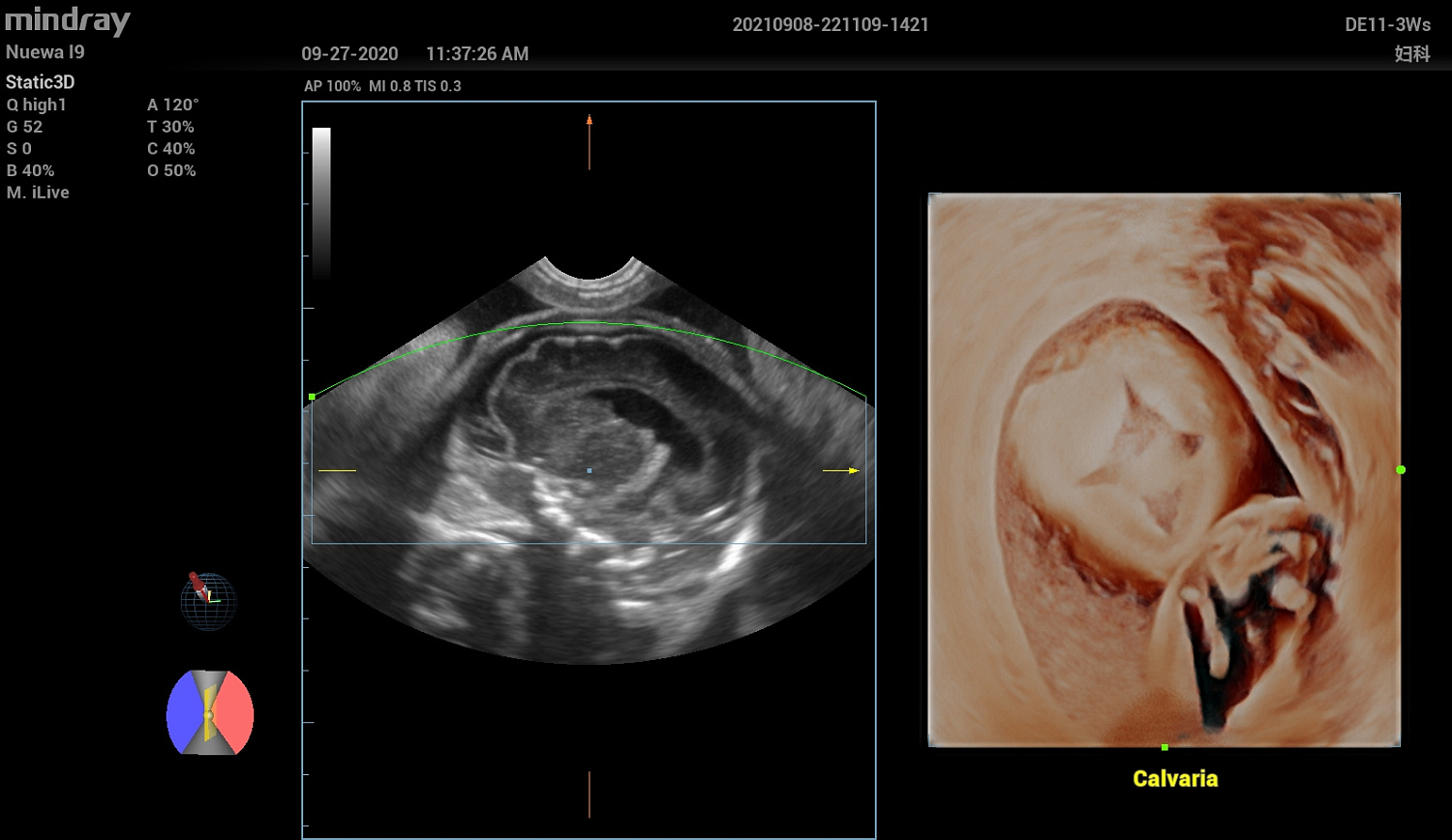 Ультразвуковой аппарат Mindray Imagyn I9