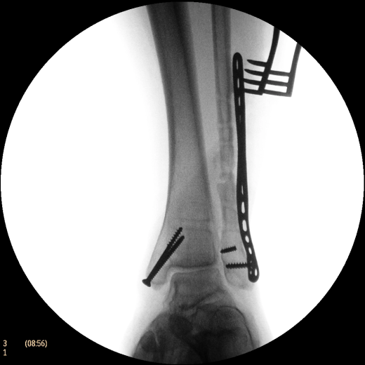 Флюороскопическая рентгеновская система с С-дугой Philips BV Endura