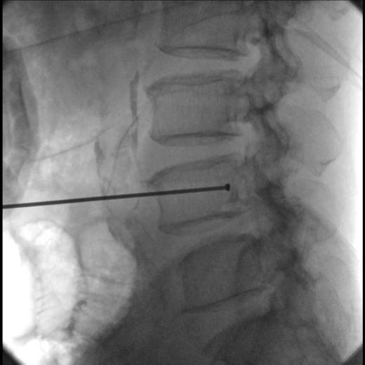 Гелпик «РЕНЕКС» 15 кВт мобильный рентгенохирургический аппарат типа С-дуга С.П. с плоскопанельным детектором
