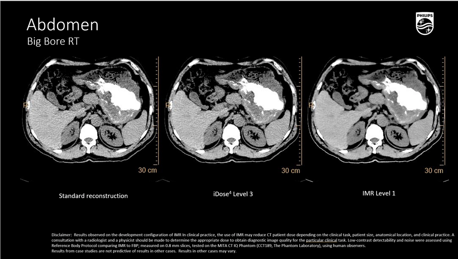 Компьютерный томограф Philips CT Big Bore