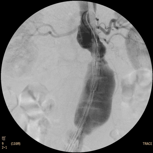 Флюороскопическая рентгеновская система с С-дугой Philips Zenition 50