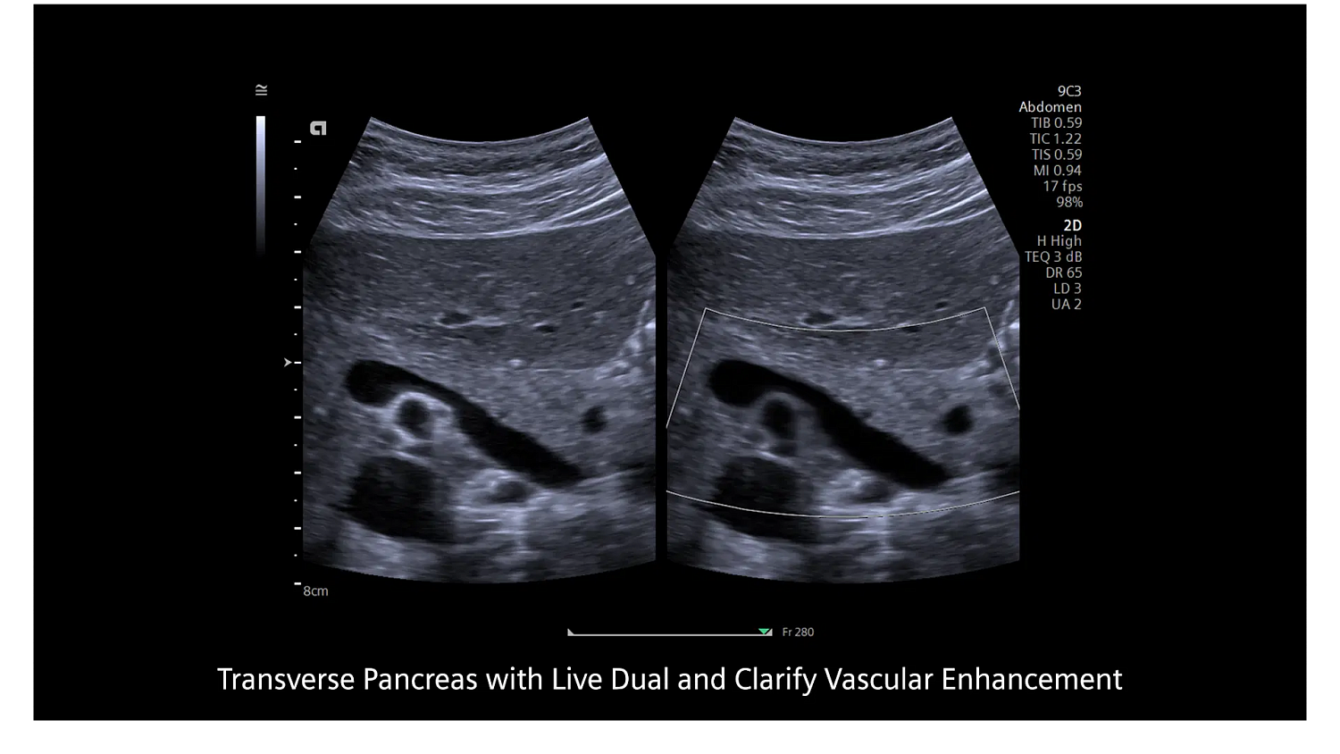 Ультразвуковая система Siemens ACUSON Redwood