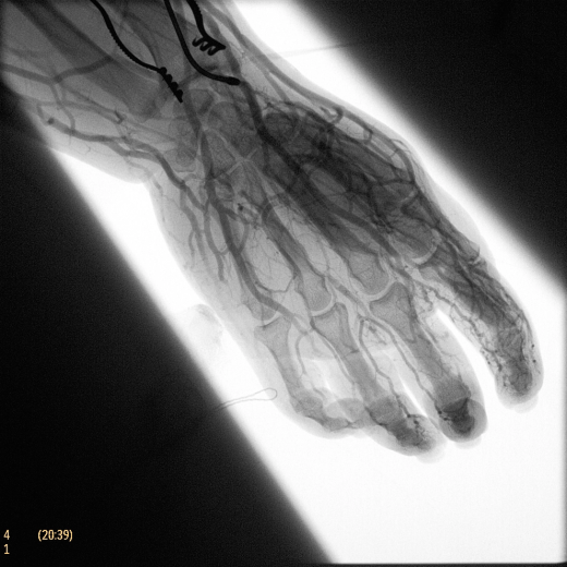 Флюороскопическая рентгеновская система с С-дугой Philips Zenition 70