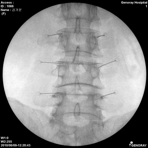 Мобильный рентгенохирургический аппарат типа С-дуга С.П. Гелпик АРХМ-РЕНЕКС