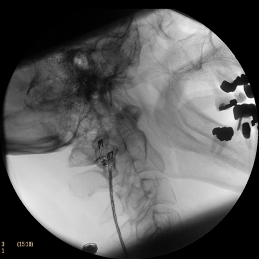 Флюороскопическая рентгеновская система с С-дугой Philips Zenition 50