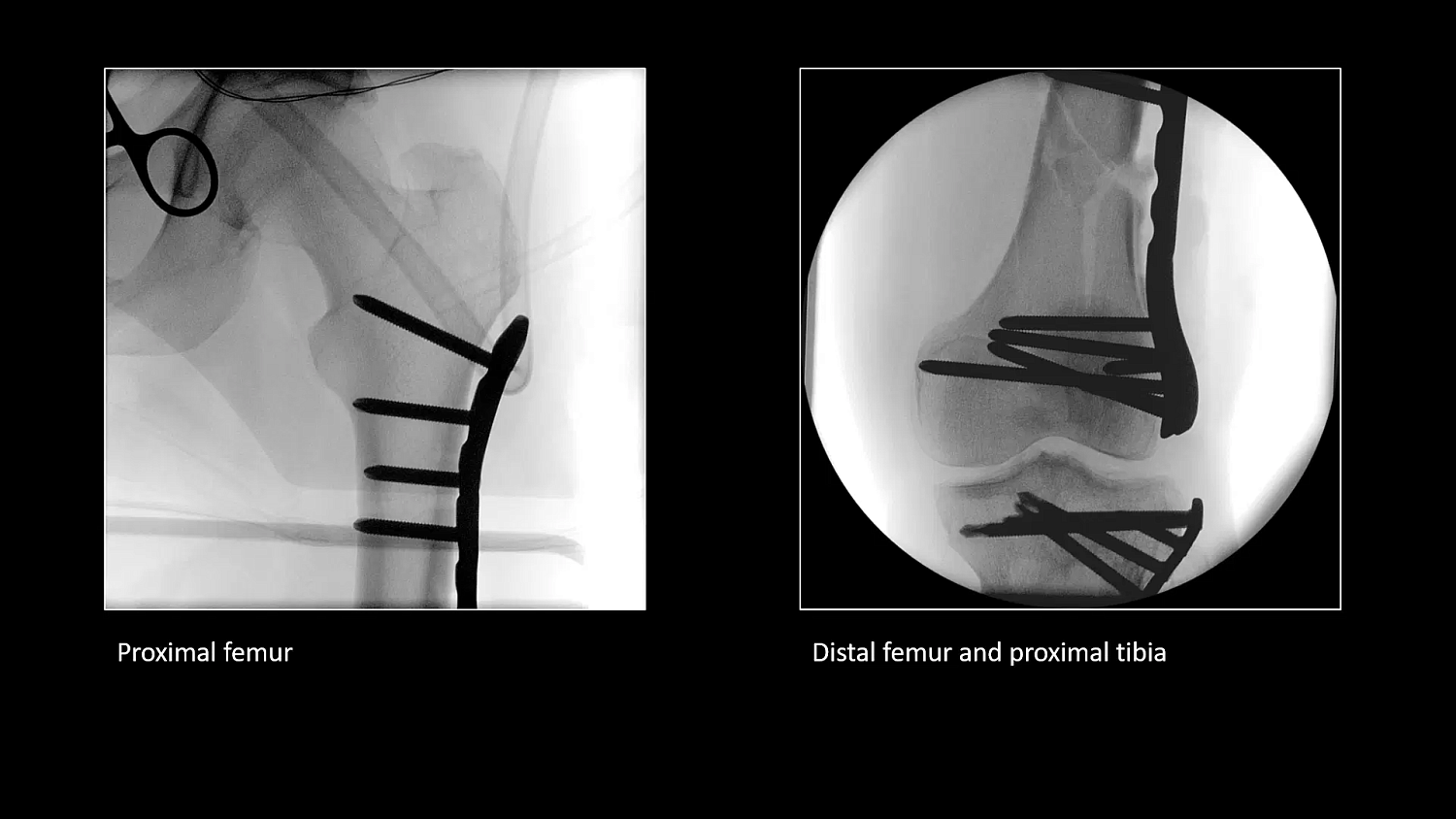 Мобильный рентгеновский аппарат с С-дугой Siemens Cios Select