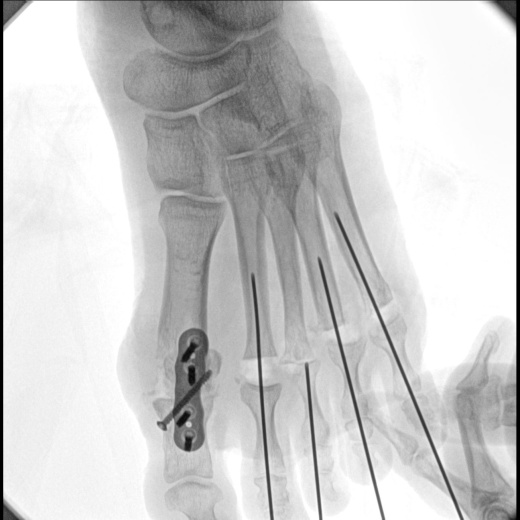 Гелпик «РЕНЕКС» 15 кВт мобильный рентгенохирургический аппарат типа С-дуга С.П. с плоскопанельным детектором