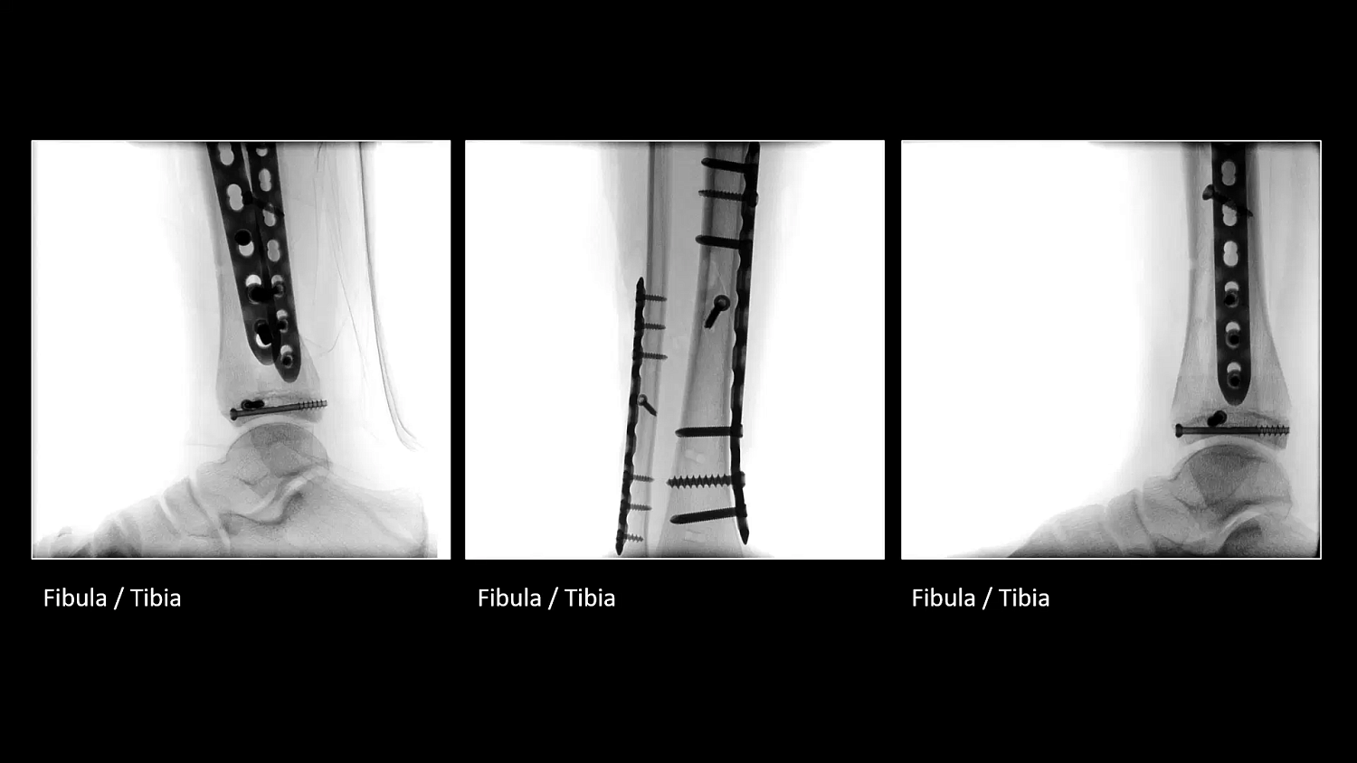 Мобильный рентгеновский аппарат с С-дугой Siemens Cios Select