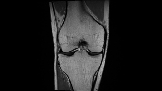 Катушка для коленного сустава Siemens Tx/Rx Knee 15 Flare Coil1